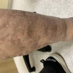 (皮膚科)下肢静脈瘤、足に湿疹ができることもあり要注意です！（外来）本日皮膚科代診です。